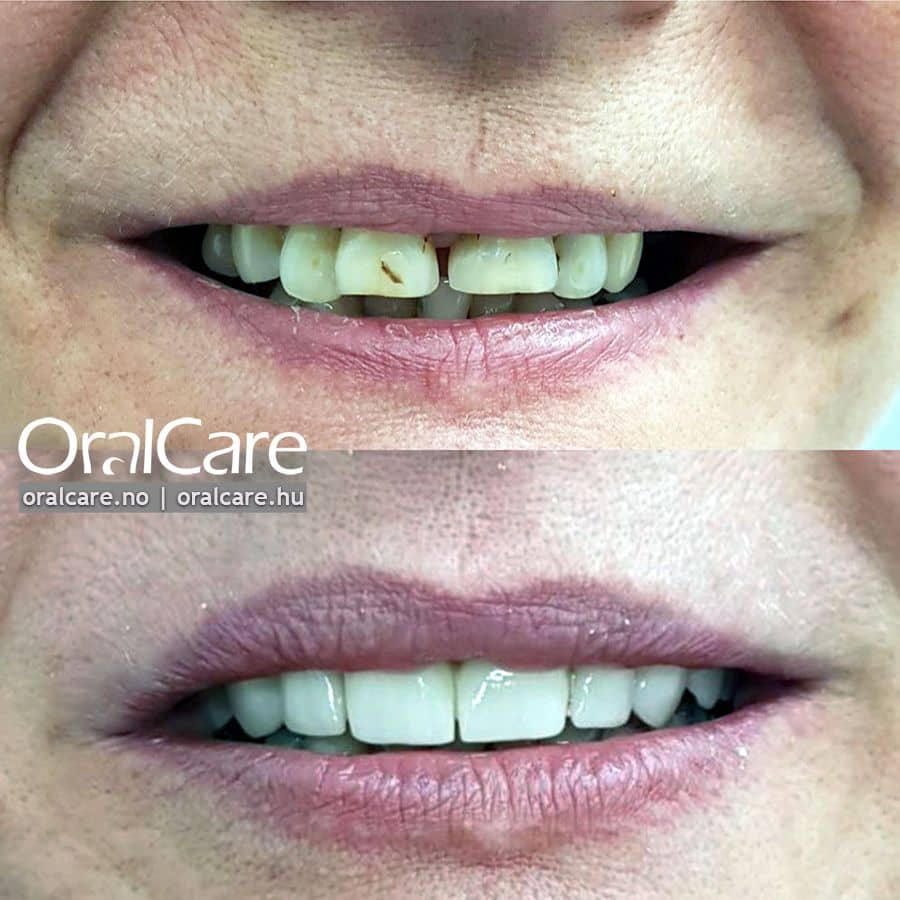 Tannkroner overkjeve